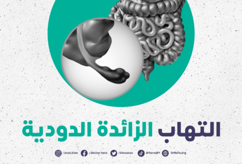 التهاب الزائدة الدودية